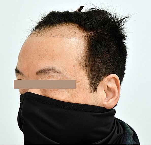 Hair Transplant Before & After