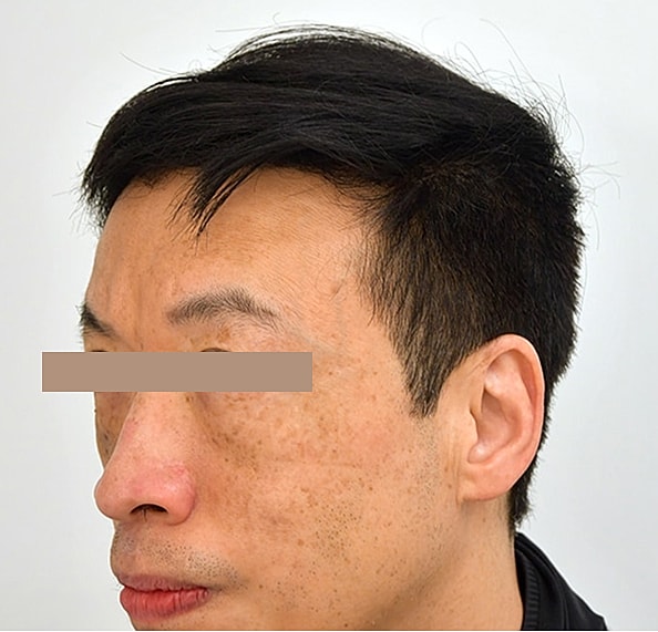 Hair Transplant Before & After