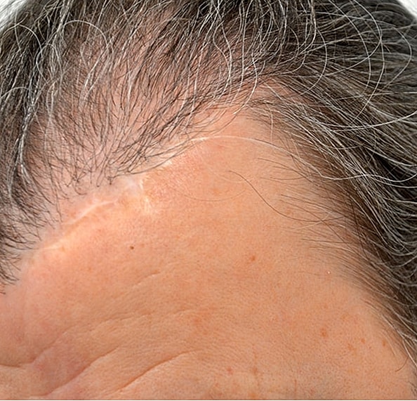 Hair Transplant Before & After