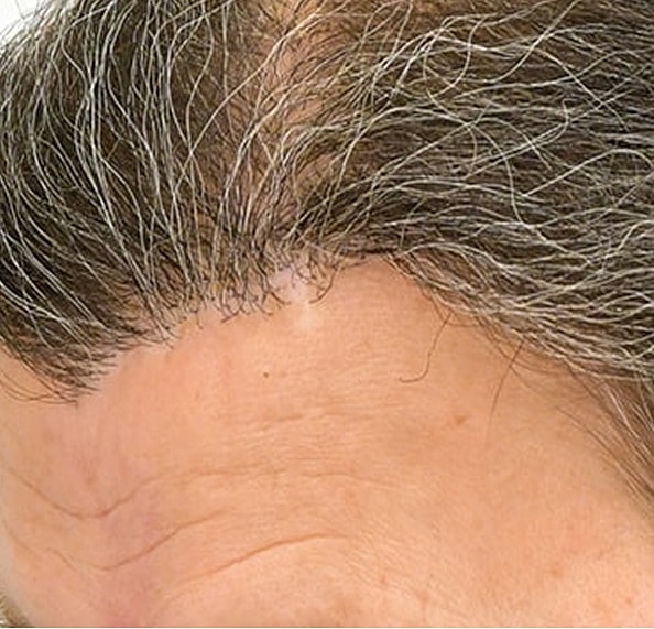 Hair Transplant Before & After