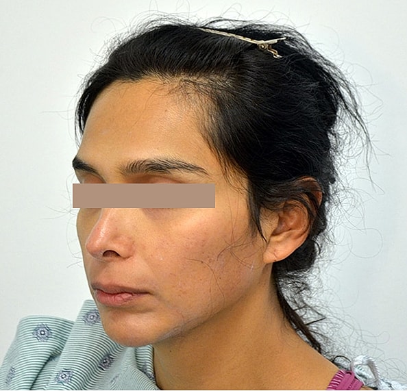 Hair Transplant Before & After