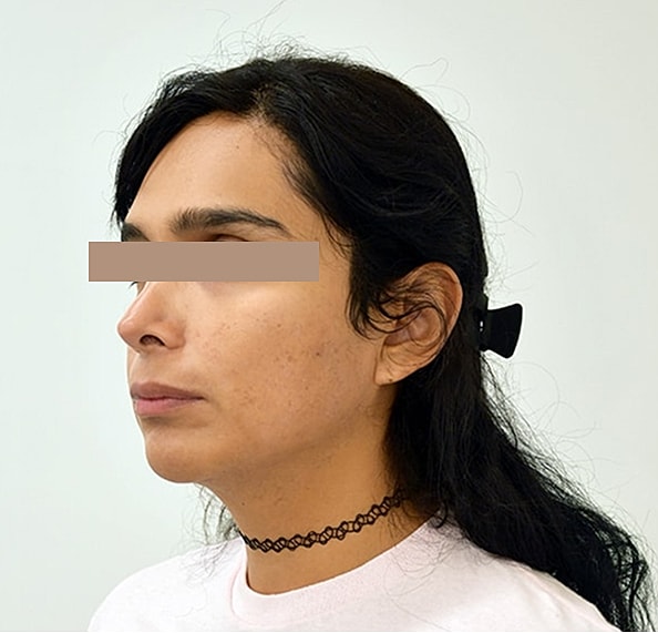 Hair Transplant Before & After