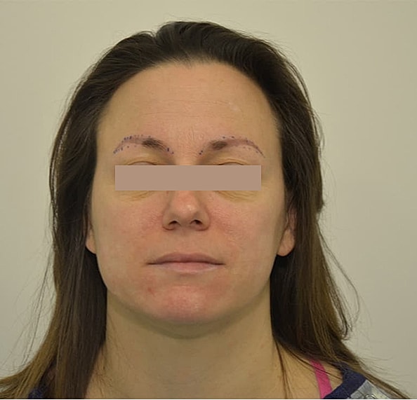 Hair Transplant Before & After