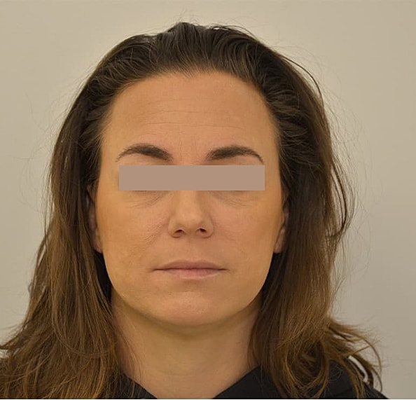 Hair Transplant Before & After