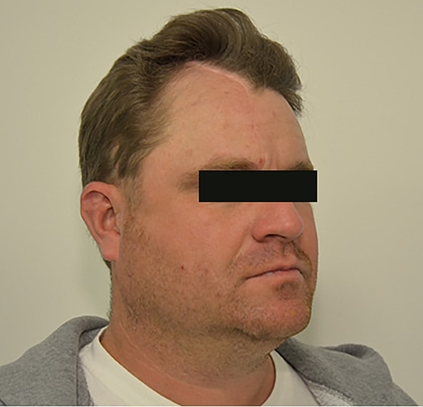 Hair Transplant Before & After