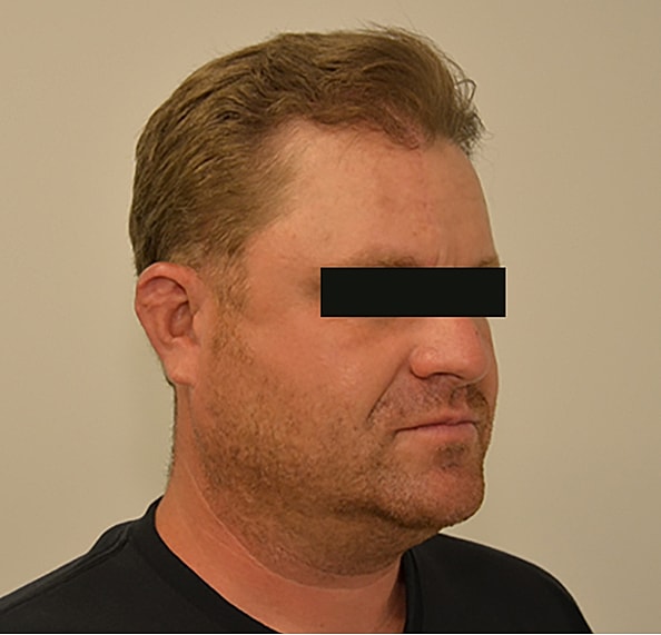 Hair Transplant Before & After