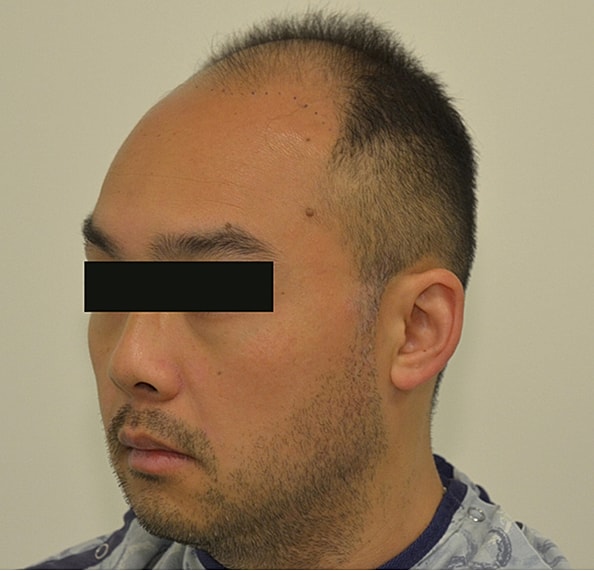 Hair Transplant Before & After