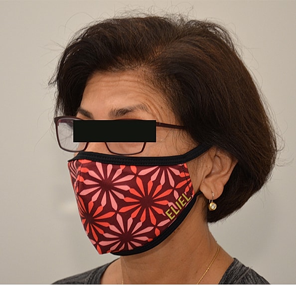 Hair Transplant Before & After