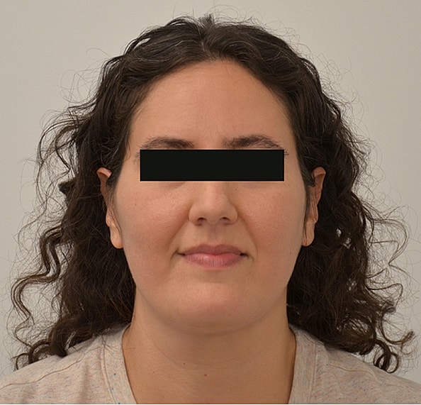 Hair Transplant Before & After