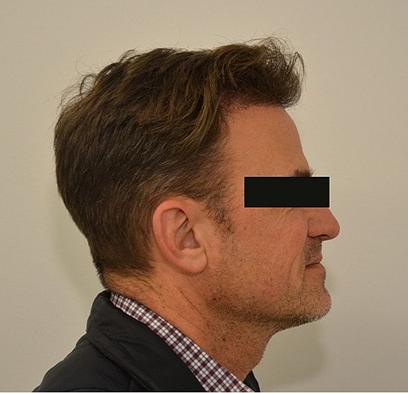 Hair Transplant Before & After