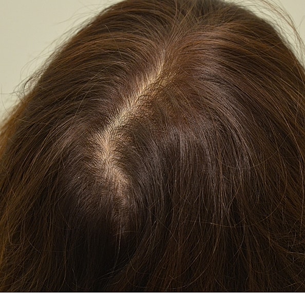 Hair Transplant Before & After