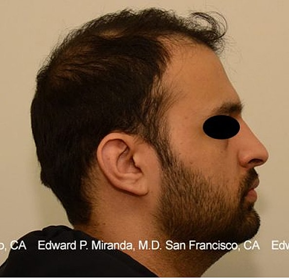 Hair Transplant Before & After