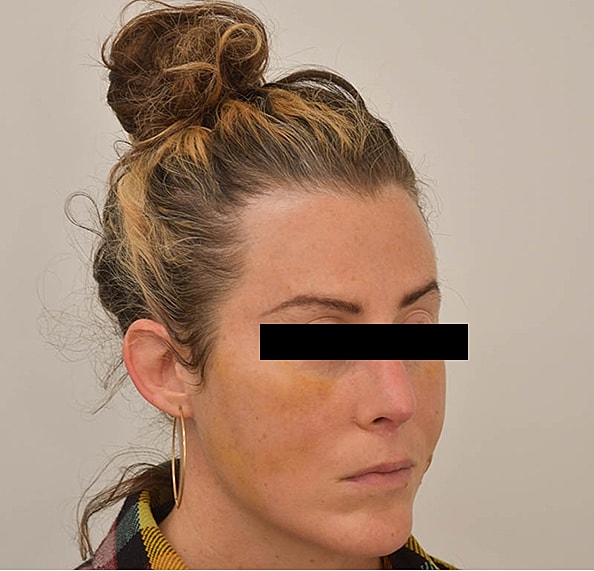 Hair Transplant Before & After