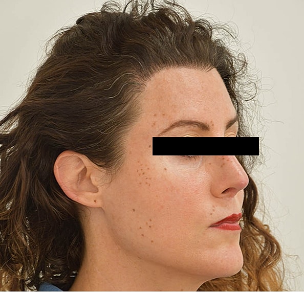 Hair Transplant Before & After