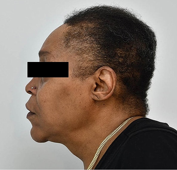 Hair Transplant Before & After