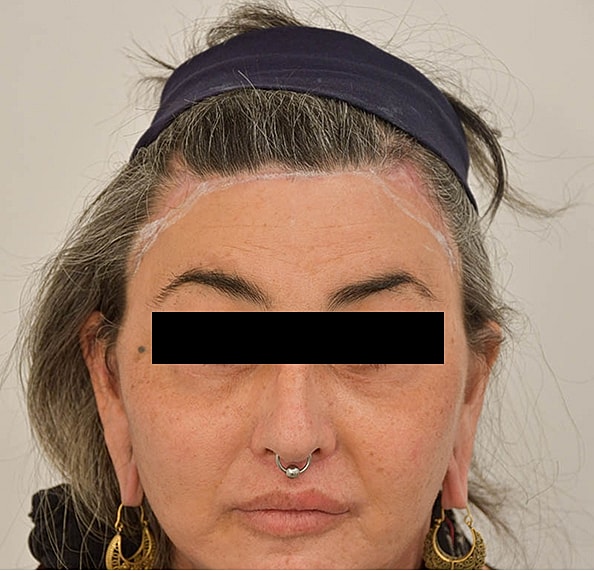 Hair Transplant Before & After