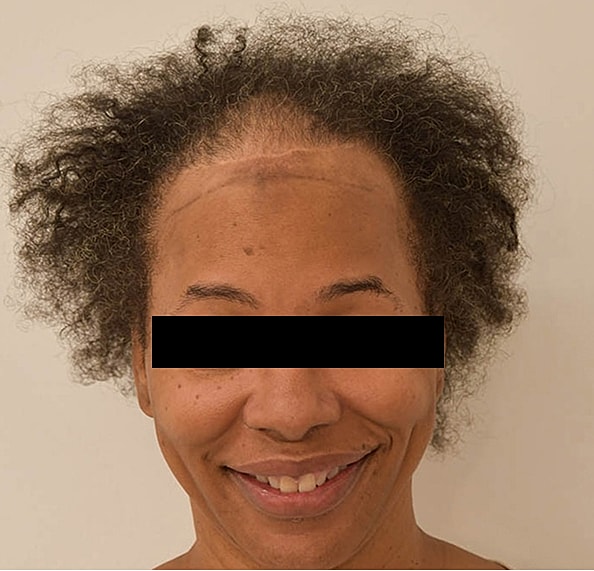 Hair Transplant Before & After