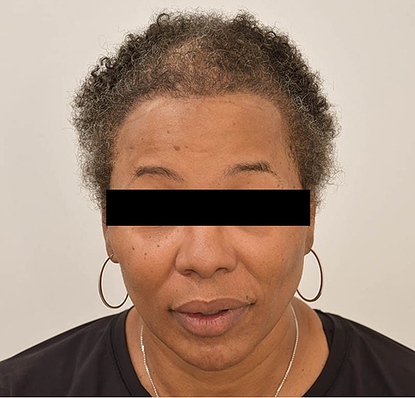 Hair Transplant Before & After