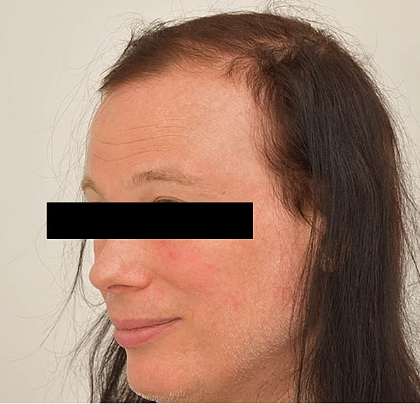 Hair Transplant Before & After