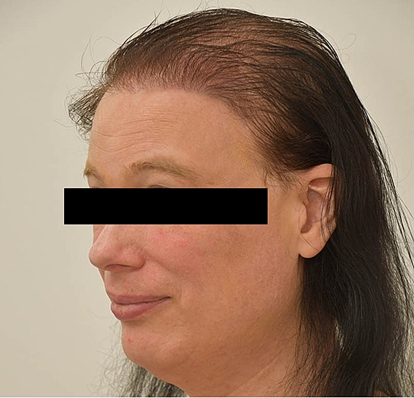 Hair Transplant Before & After