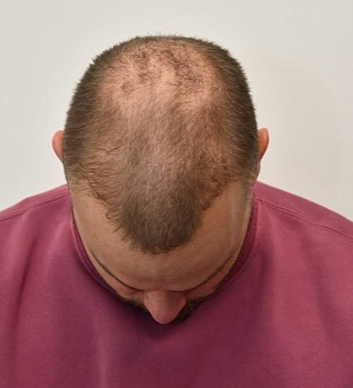 Man with receding hairline looking downwards.