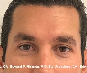 Neurotoxins Before & After