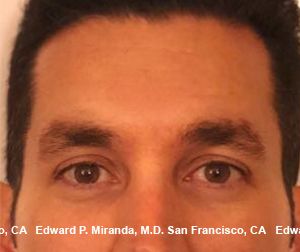 Neurotoxins Before & After