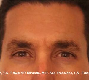 Neurotoxins Before & After