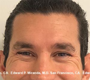 Neurotoxins Before & After