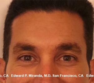 Neurotoxins Before & After