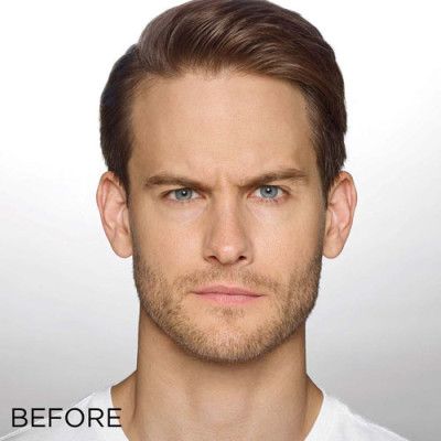 Neurotoxins Before & After