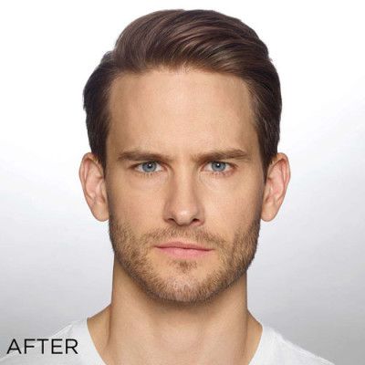 Neurotoxins Before & After