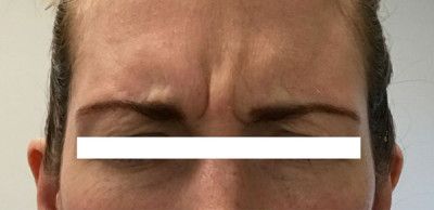 Neurotoxins Before & After