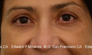 Neurotoxins Before & After