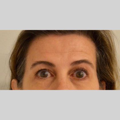 Neurotoxins Before & After