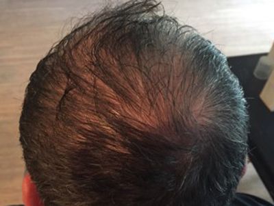 Prp For Hair Loss Before & After
