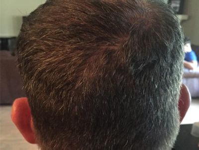 Prp For Hair Loss Before & After