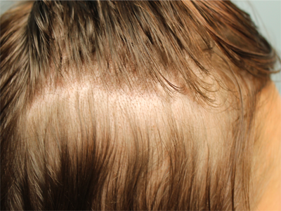 Prp For Hair Loss Before & After