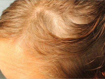 Prp For Hair Loss Before & After