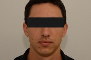 Scar Revision Before & After