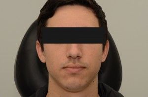 Scar Revision Before & After