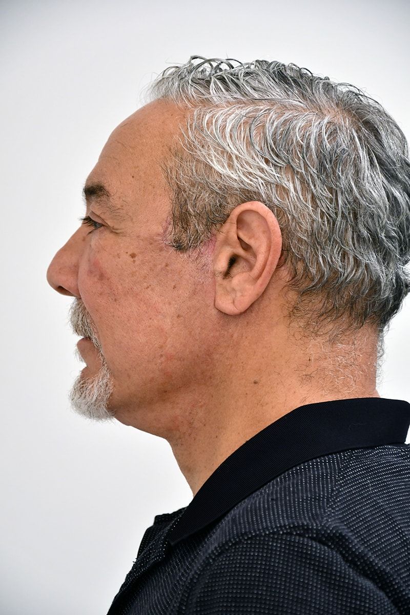 Fat Grafting Before & After