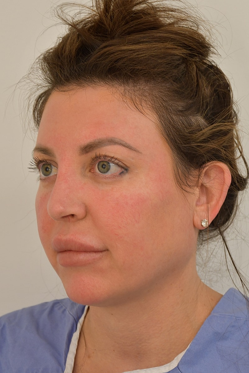 Fat Grafting Before & After