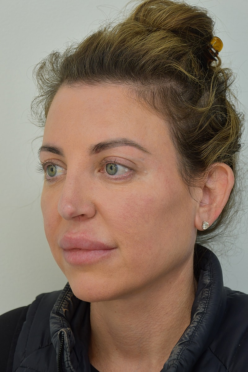 Fat Grafting Before & After