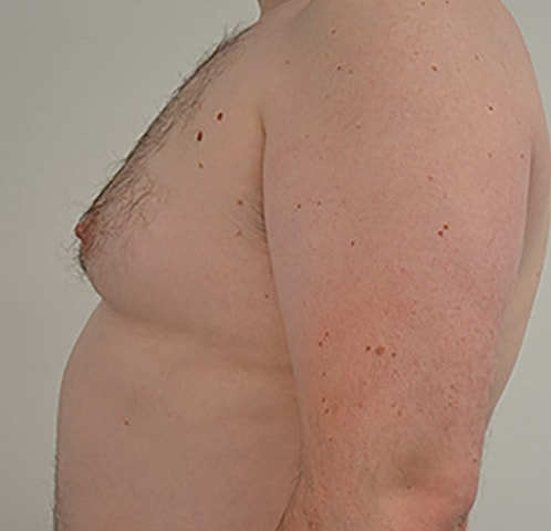 Gynecomastia Before & After