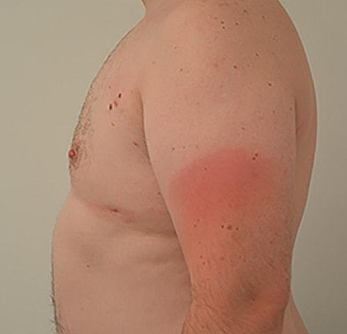 Gynecomastia Before & After