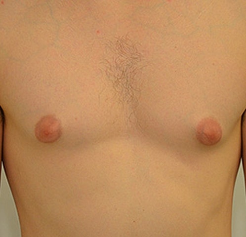 Gynecomastia Before & After