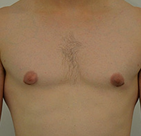 Gynecomastia Before & After