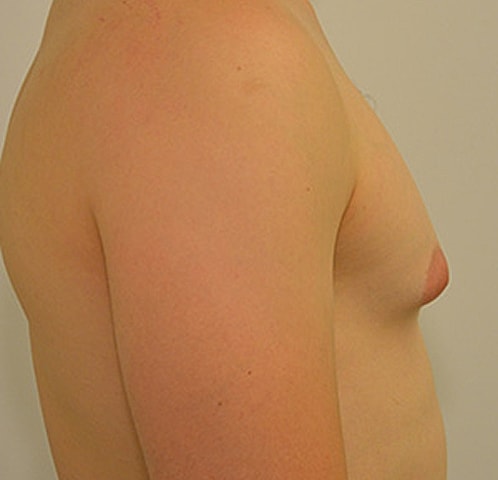 Gynecomastia Before & After