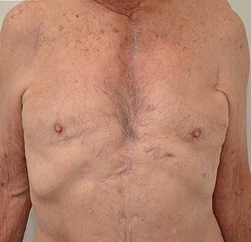 Gynecomastia Before & After
